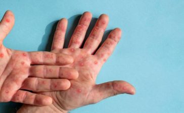 Acumula Puebla 10 casos de viruela símica: Salud