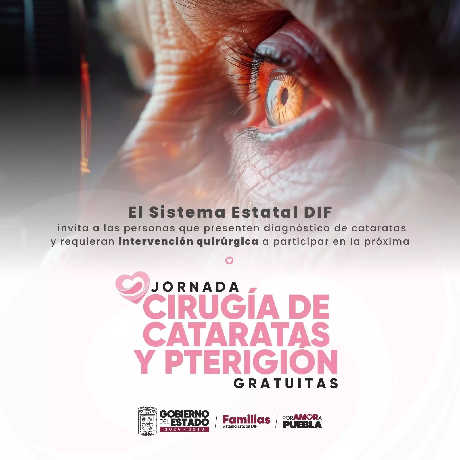 SEDIF lanza jornada gratuita de cirugías de cataratas y pterigión en Puebla